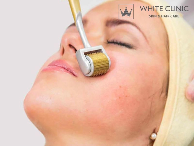 phương pháp trị sẹo rỗ phương pháp trị sẹo rỗ