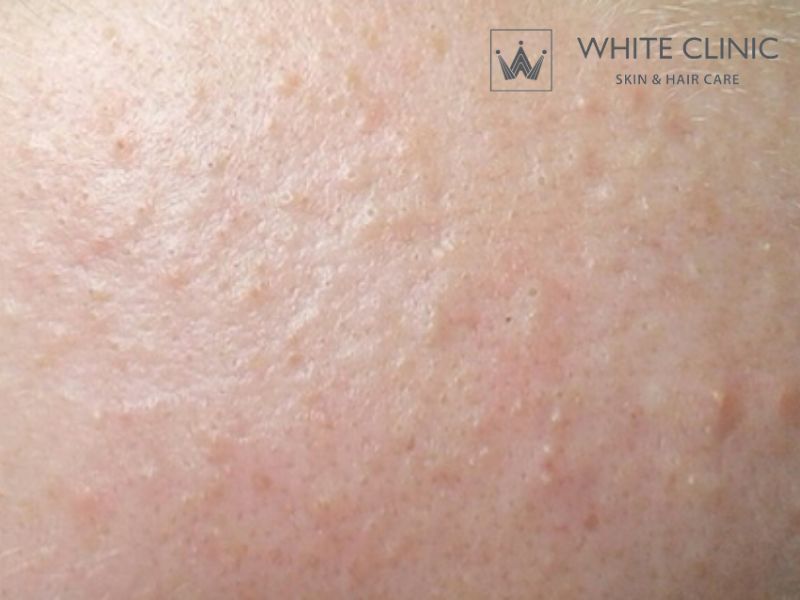 Mụn Sẩn Là Gì? Nguyên Nhân Gây Mụn Và Cách Xử Lý Hiệu Quả 