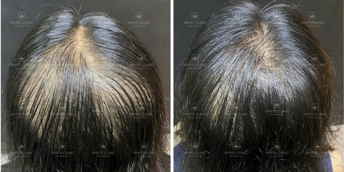 Rụng tóc kiểu hói ở nữ