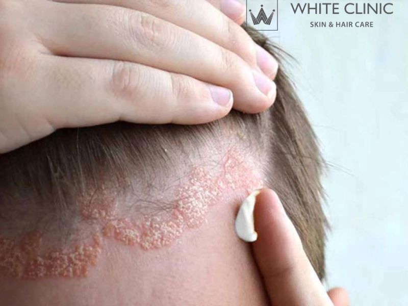 da đầu yếu da đầu yếu