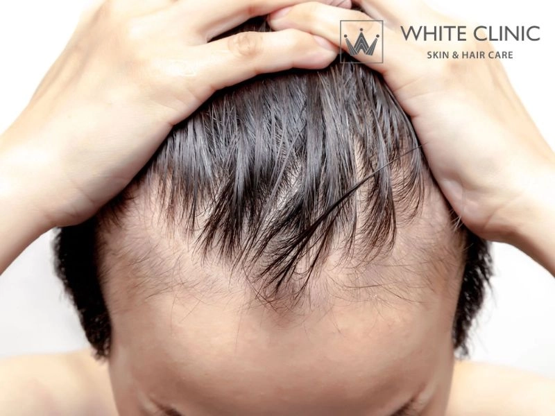 Các Nguyên Nhân Rụng Tóc Ở Nam Và Cách Khắc Phục Hiệu Quả