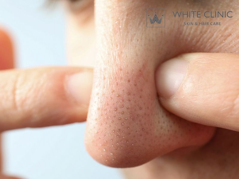 Mụn Đầu Đen: Nguyên Nhân Và Phương Pháp Điều Trị Hiệu Quả 