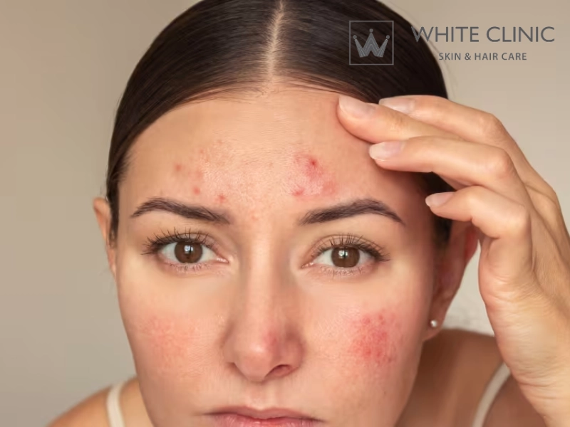 mặt nạ thiên nhiên trị thâm mụn