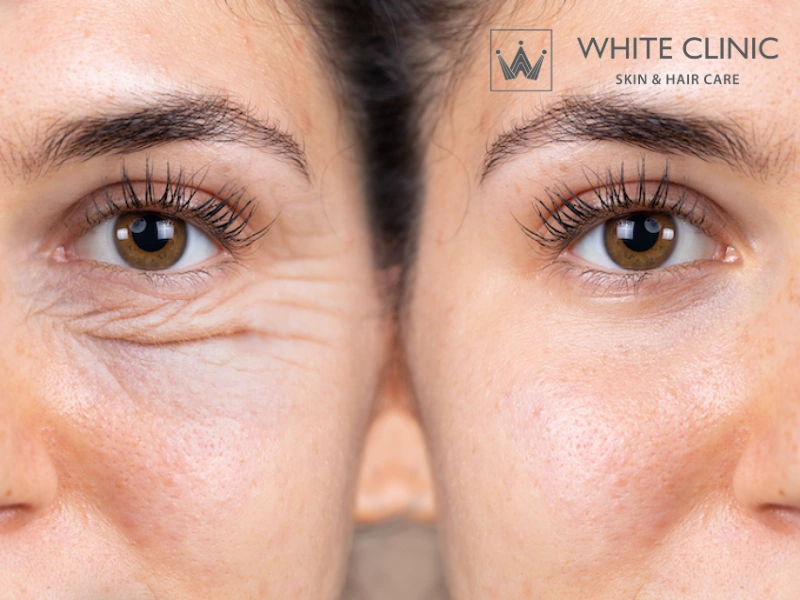 trẻ hóa da bằng laser có tốt không