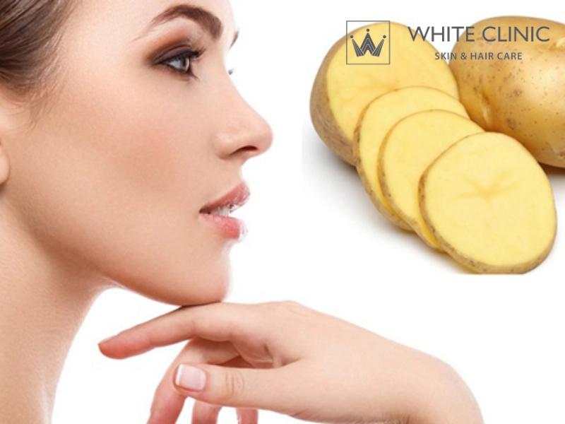 cách làm mặt nạ khoai tây trị thâm mụn cách làm mặt nạ khoai tây trị thâm mụn