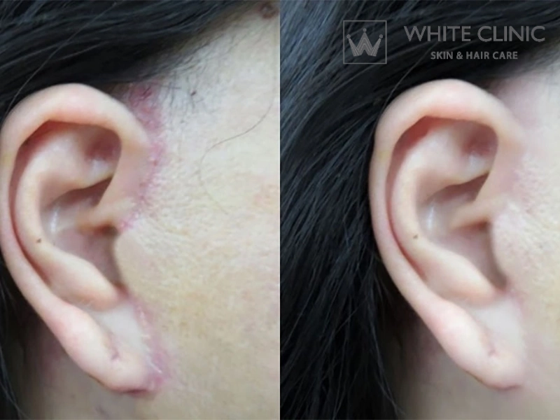Xây dựng phác đồ cá nhân hóa điều trị sẹo căng da mặt Xây dựng phác đồ cá nhân hóa điều trị sẹo căng da mặt