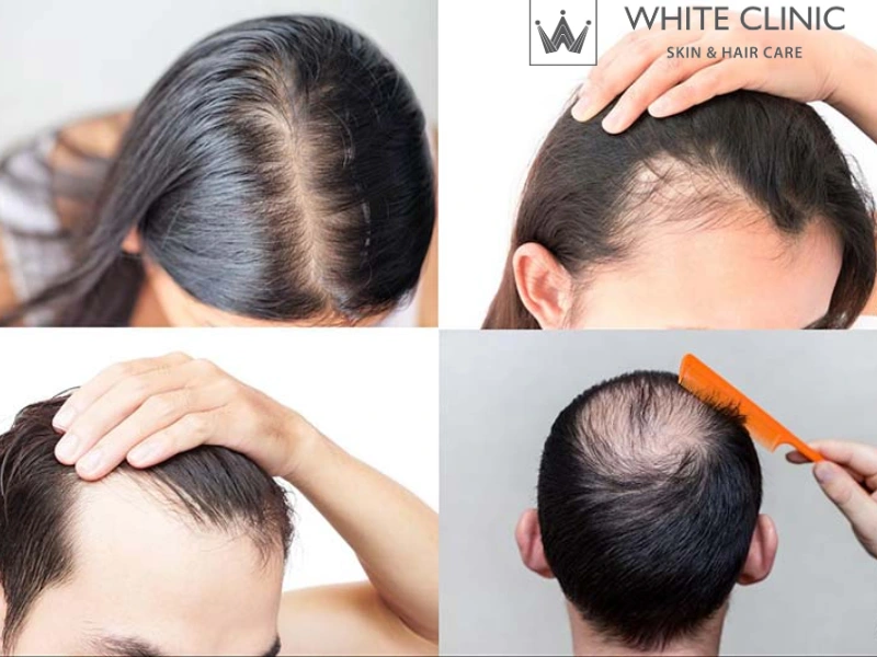 nguyên nhân gây rụng tóc nguyên nhân gây rụng tóc