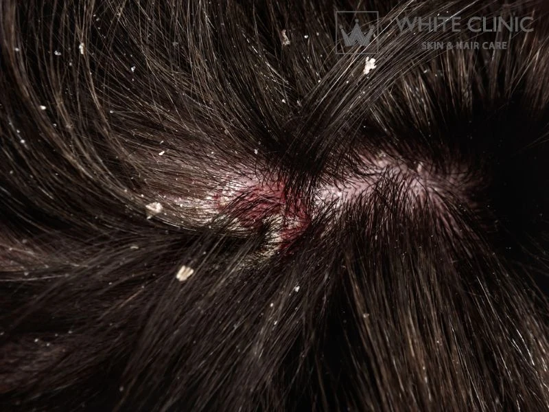 cách trị ngứa da đầu