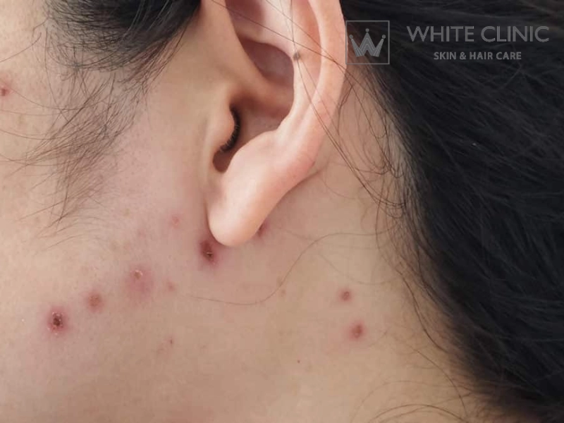 thuốc trị sẹo trái rạ
