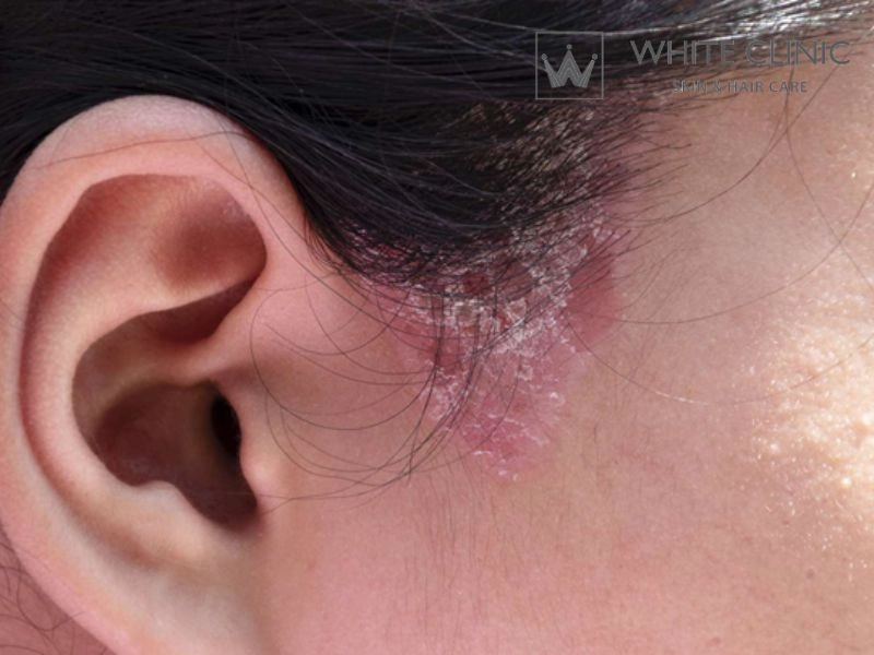 da đầu bị đỏ da đầu bị đỏ