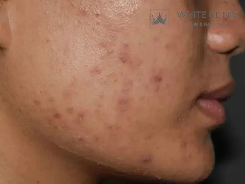 Điều Trị Tăng sắc tố sau viêm: Tại sao điều trị mãi không hết và phác đồ phục hồi an toàn