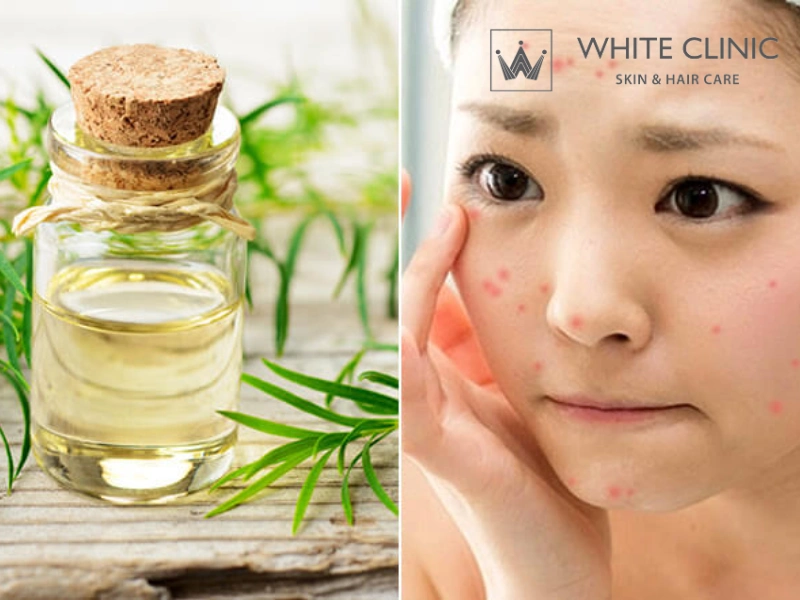 Trị Mụn Bằng Tinh Dầu Tràm Trà Hiệu Quả Và Những Lưu Ý Khi Sử Dụng 