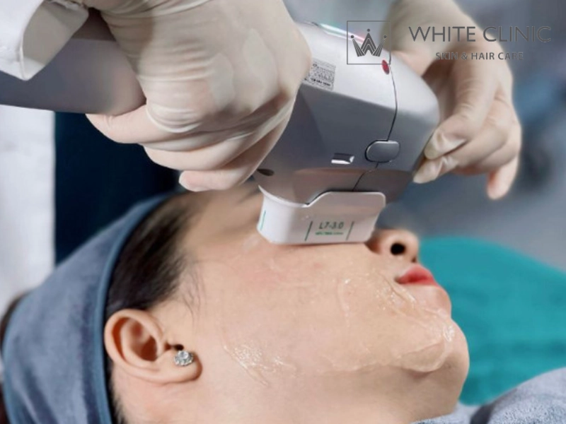 công nghệ hifu ultherapy công nghệ hifu ultherapy