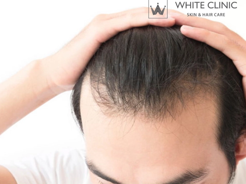 Cách Trị Hói Đầu Hiệu Quả Từ Liệu Pháp Đột Phá Tại White Clinic