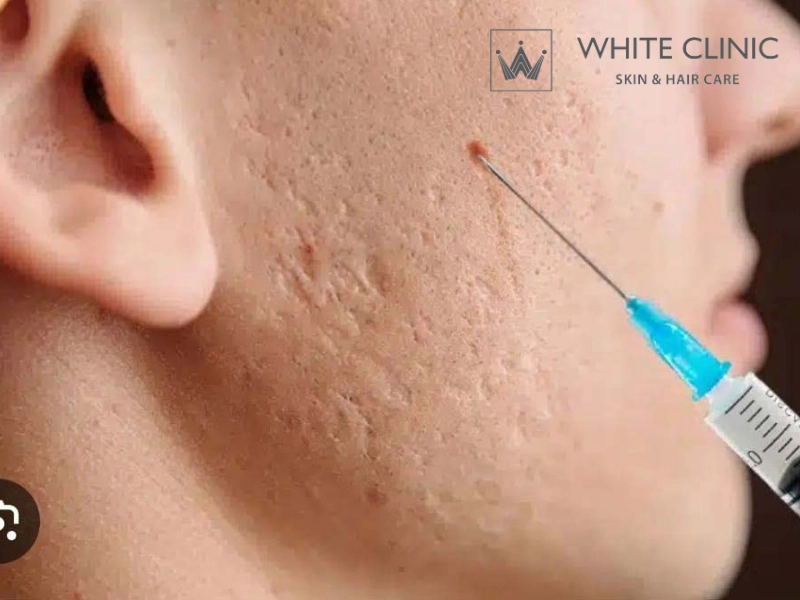 tiêm filler làm đầy sẹo lõm tiêm filler làm đầy sẹo lõm
