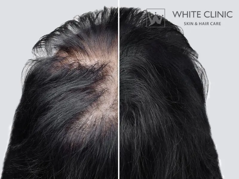 bị hói ở đỉnh đầu nữ