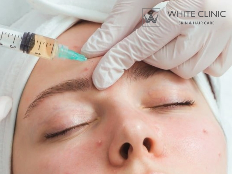 Da Mụn Có Tiêm Meso Được Không? Tư Vấn Chuyên Sâu Từ White Clinic