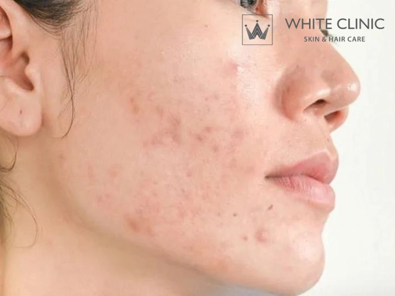 Bắn laser trị thâm: Hiểu đúng về cơ chế để tránh thâm ngược và sạm da