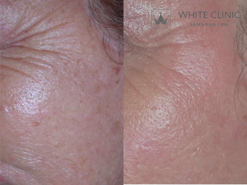 cách trị nếp nhăn ở mắt