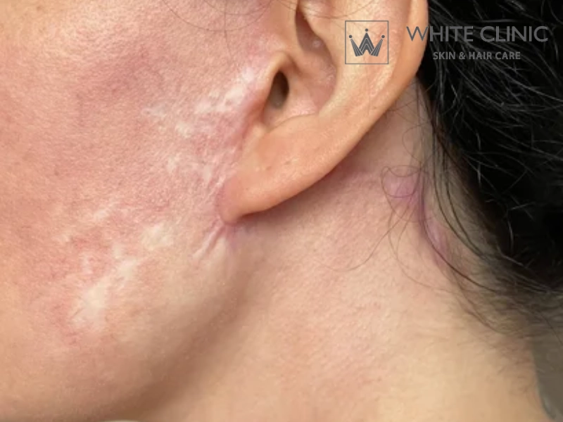 sẹo căng da mặt sẹo căng da mặt