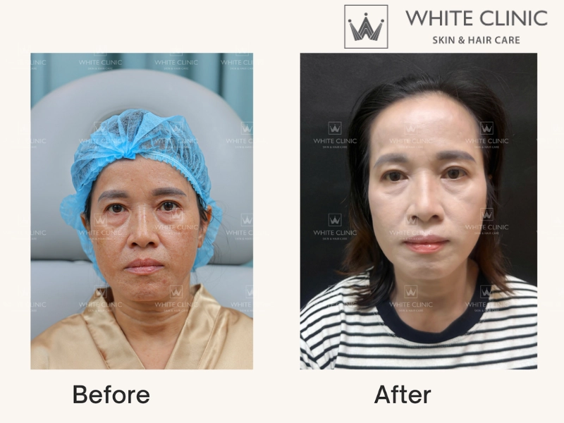 Bio Lift 20 Bio Lift 20