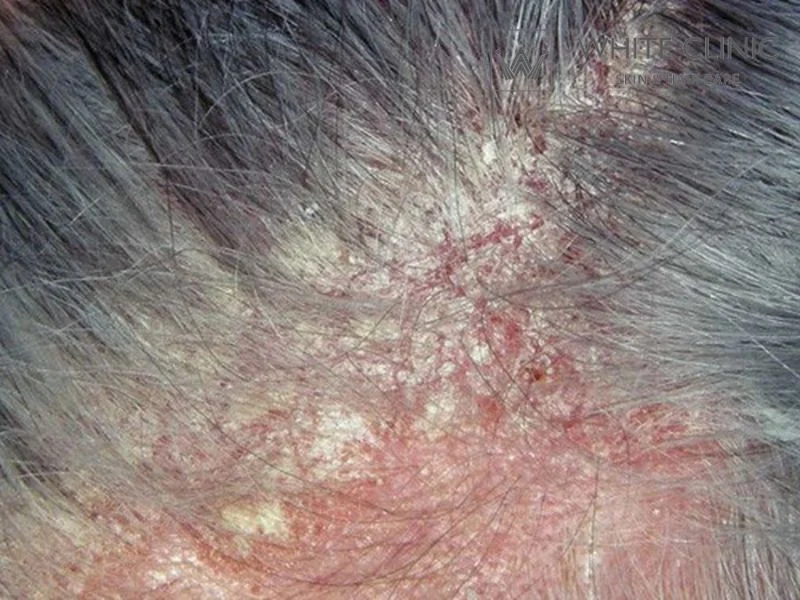 da đầu bị đỏ da đầu bị đỏ