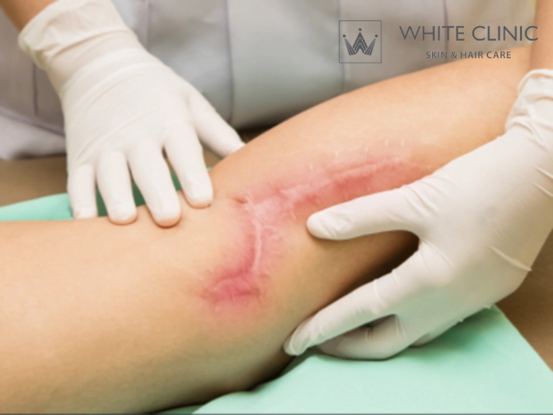 Điều Trị Sẹo Tai Nạn: Phân Loại, Thời Điểm Can Thiệp Và Phác Đồ Cá Nhân Hóa