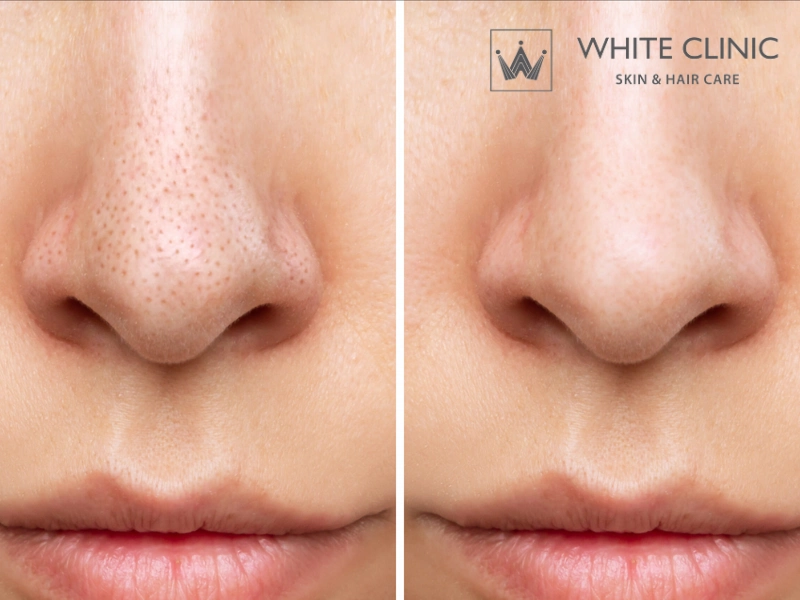 laser co2 fractional trị lỗ chân lông to