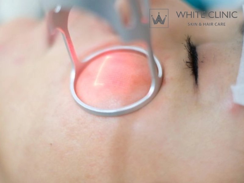 laser co2 fractional có đau không laser co2 fractional có đau không