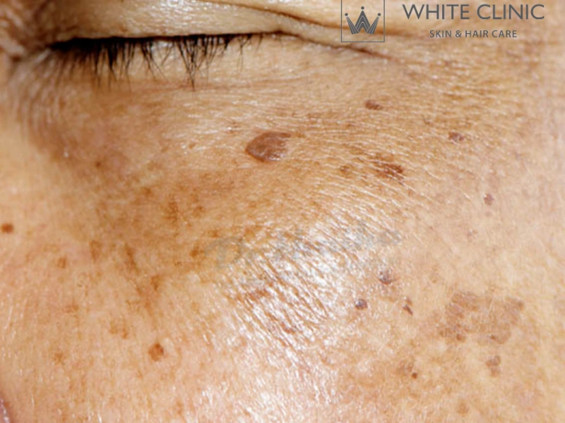 rối loạn sắc tố da rối loạn sắc tố da