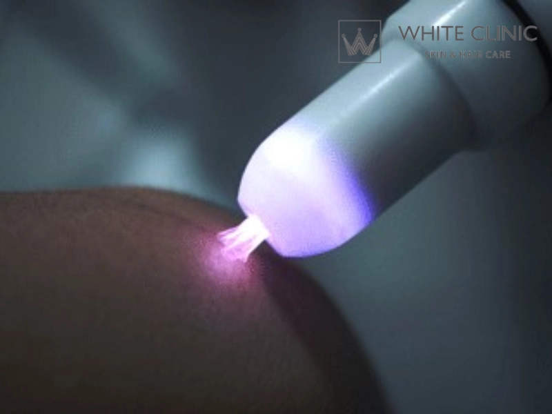 Plasma Lạnh Trong Điều Trị Da Và Rụng Tóc: Hiểu Đúng Cơ Chế Để Tránh Rủi Ro