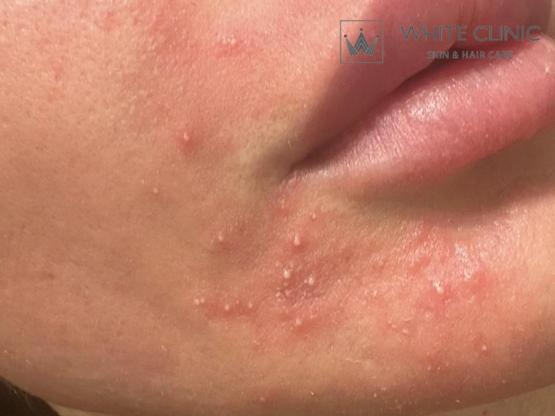 Phản ứng bình thường (Có thể tự chăm sóc tại nhà) Phản ứng bình thường (Có thể tự chăm sóc tại nhà)