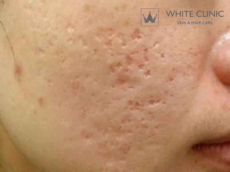 tiêm filler làm đầy sẹo lõm tiêm filler làm đầy sẹo lõm