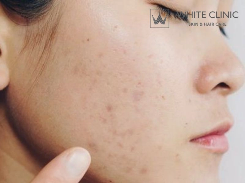 tăng sắc tố sau viêm tăng sắc tố sau viêm