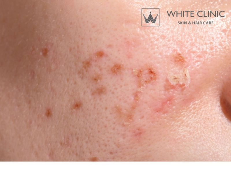 laser trị thâm laser trị thâm