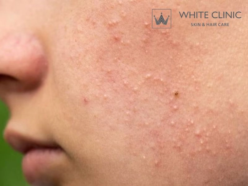 mụn đầu trắng