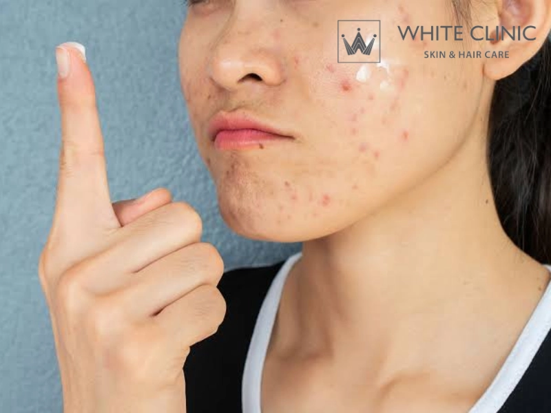 cách chữa mụn thâm ở má