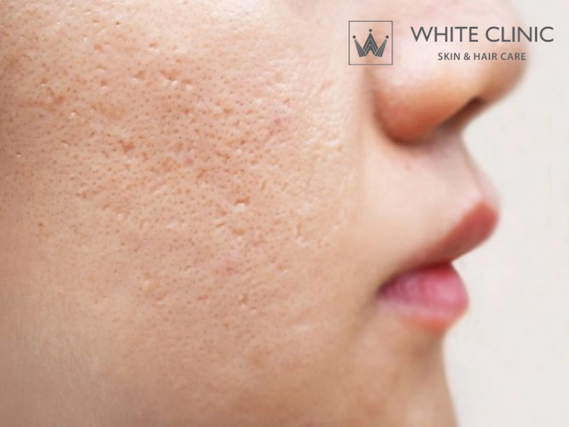Sẹo đáy nhọn (Ice pick scars) Sẹo đáy nhọn (Ice pick scars)