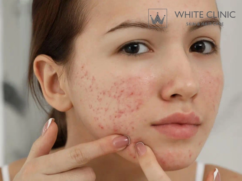 thâm mụn có tự hết không thâm mụn có tự hết không