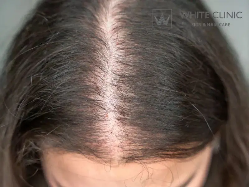 bị hói ở đỉnh đầu nữ