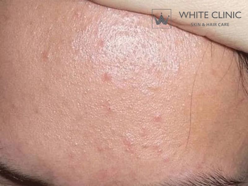 mặt nạ thiên nhiên trị mụn và vết thâm