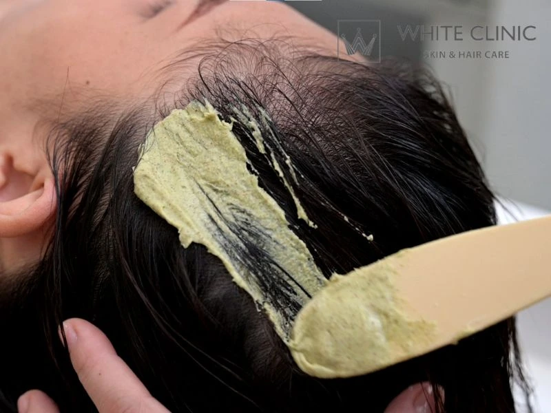 alopecia areata là gì alopecia areata là gì