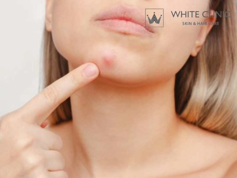 Mọc Mụn Ở Cằm Là Do Đâu? Những Điều Cần Lưu Ý Khi Điều Trị Mụn 