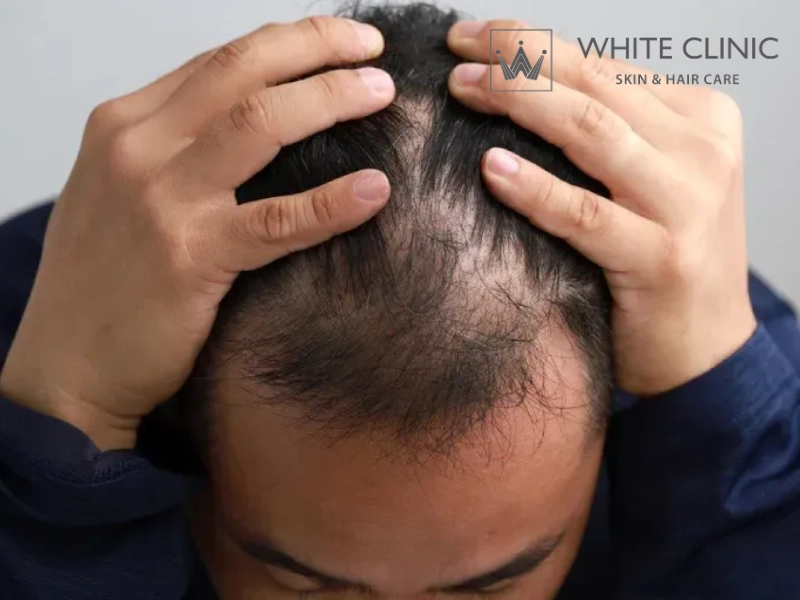 rụng tóc không rõ nguyên nhân rụng tóc không rõ nguyên nhân