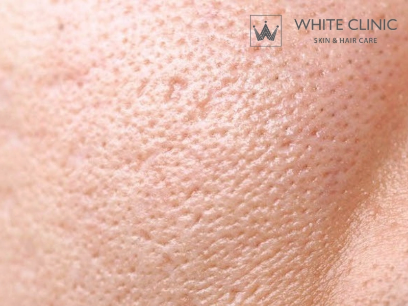 tiêm filler làm đầy sẹo lõm tiêm filler làm đầy sẹo lõm