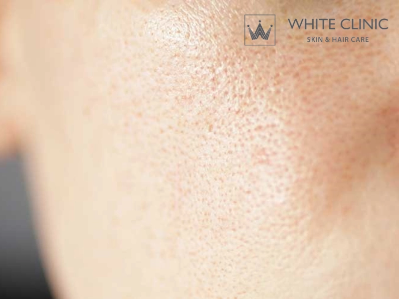 Phân Biệt Sẹo Đáy Nhọn Và Lỗ Chân Lông To Và Phương Pháp Điều Trị Hiệu Quả 