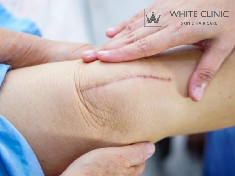 Giai đoạn lành thương và thời điểm can thiệp phù hợp Giai đoạn lành thương và thời điểm can thiệp phù hợp