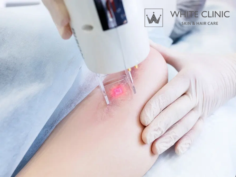 Điều Trị Sẹo Phẫu Thuật: Hiểu Đúng Phân Loại Và Giai Đoạn Để Can Thiệp An Toàn, Hiệu Quả