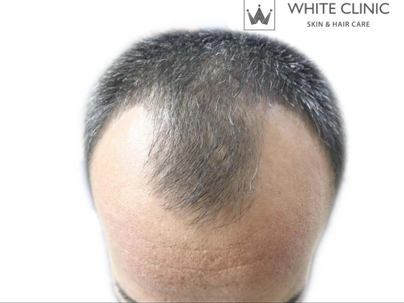 rụng tóc di truyền rụng tóc di truyền