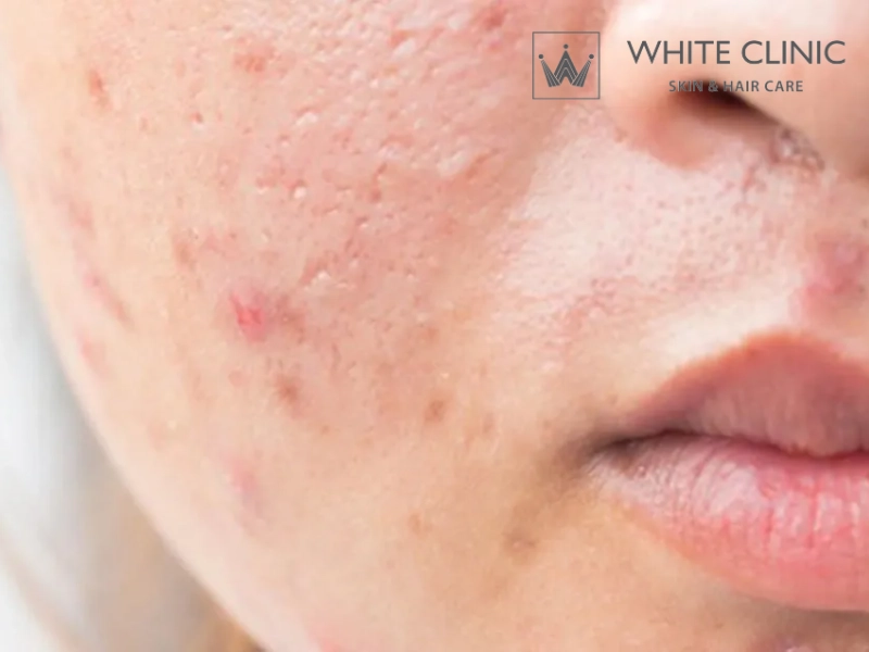 mặt nạ thiên nhiên trị mụn và vết thâm